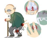 膝关节疾病需要关节置换吗？事实上，这四种疾病都需要记住。