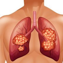 如何早期筛查肺癌？谁需要每年做胸部电脑断层扫描？医生告诉你答案。