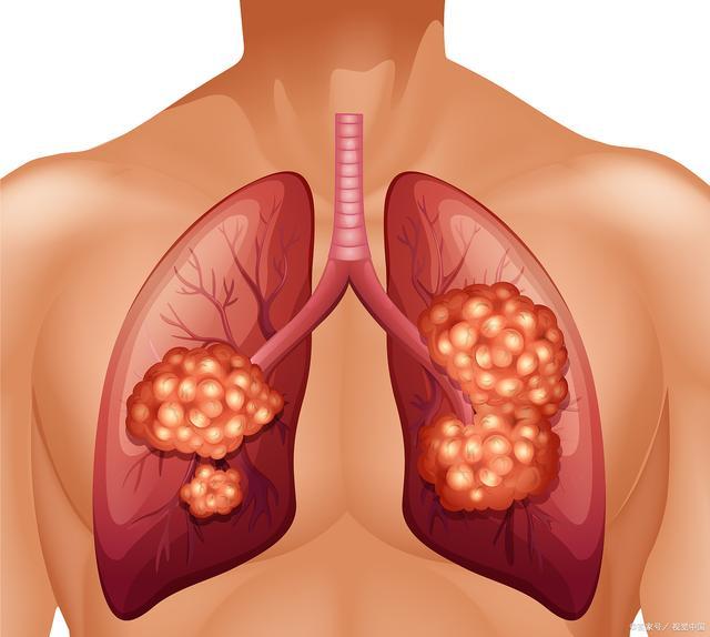 如何早期筛查肺癌？谁需要每年做胸部电脑断层扫描？医生告诉你答案。 